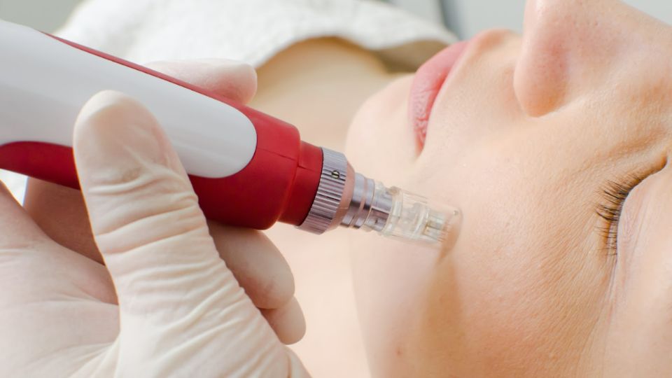 Dermapen PRP